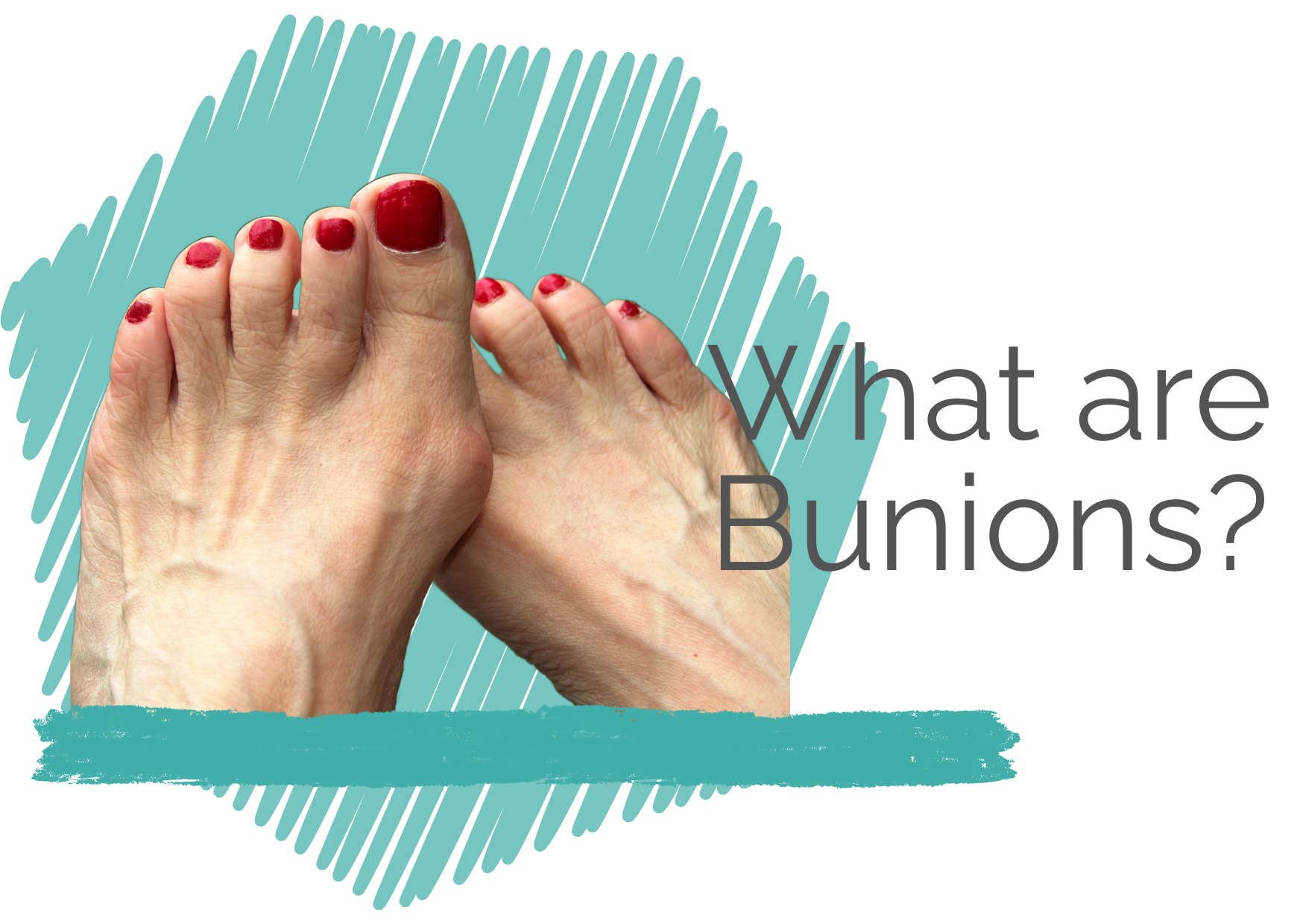 Feet with Bunions